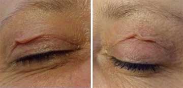Antiaging Technology Plexr Skin Rejuvenation, Spot Treatment and Wrinkle Treatment