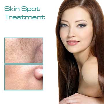 Skin spot treatment and Skin treatment with fraxel laser.
