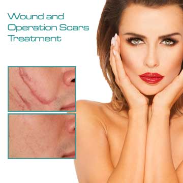 Skin treatment Wound and Operation Scar Treatment with fraxel laser 