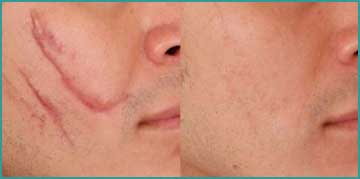 Skin treatment Wound and Operation Scar Treatment with fraxel laser