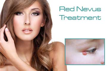 Vascular Treatments Red Nevus Treatment Detail Information