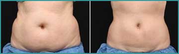 Local Slimming - Body Shaping - Weight Loss Cellulitis Cold Lypolysis