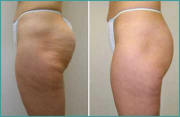 Local Slimming-Body Shaping-Weight Loss Cellulitis Velashape