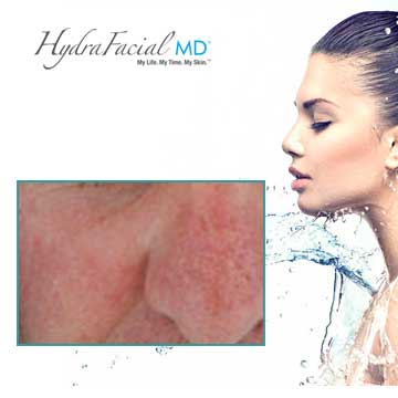 Skin Renewal Hydrafacial MD Detail Information